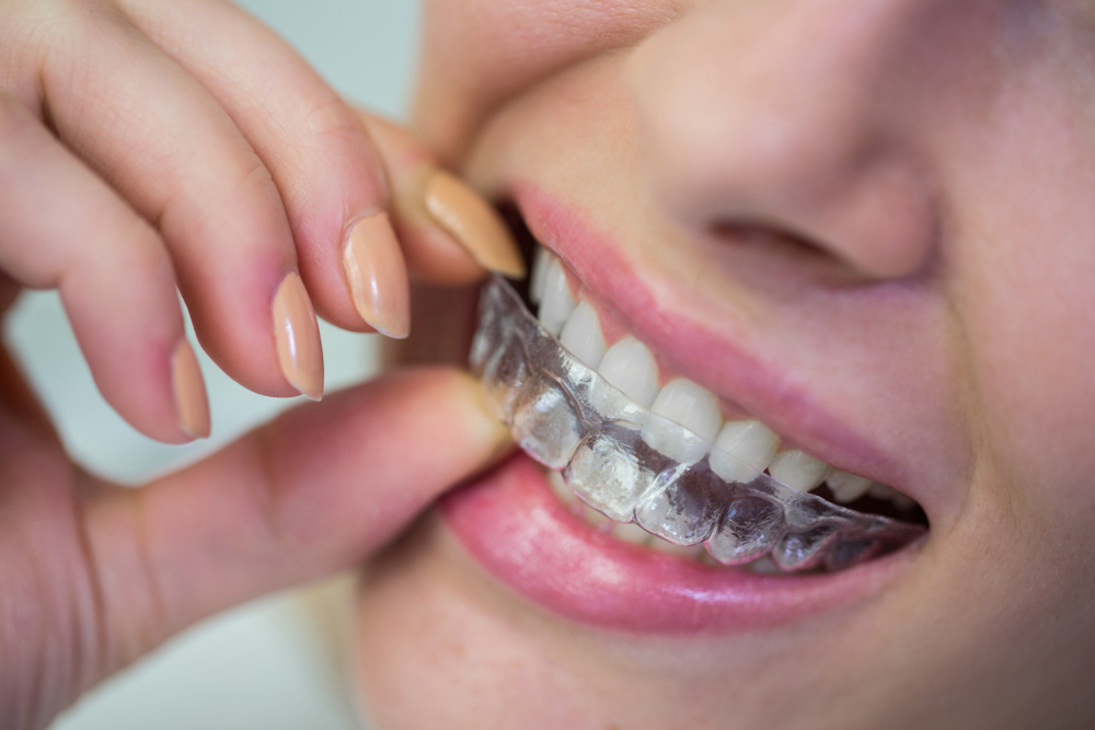 Braces and Aligners in Dahisar West