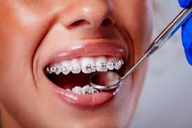 Braces and Aligners in Dahisar West