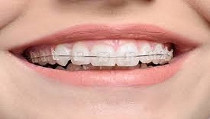 Braces and Aligners in Dahisar West