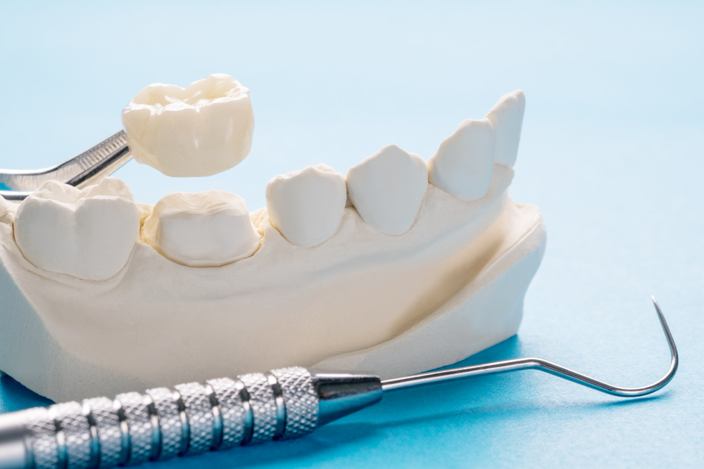 Composite Filling & Crowns in Dahisar West