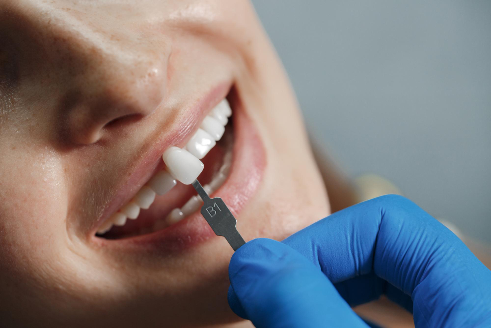 Composite Filling & Crowns in Dahisar West