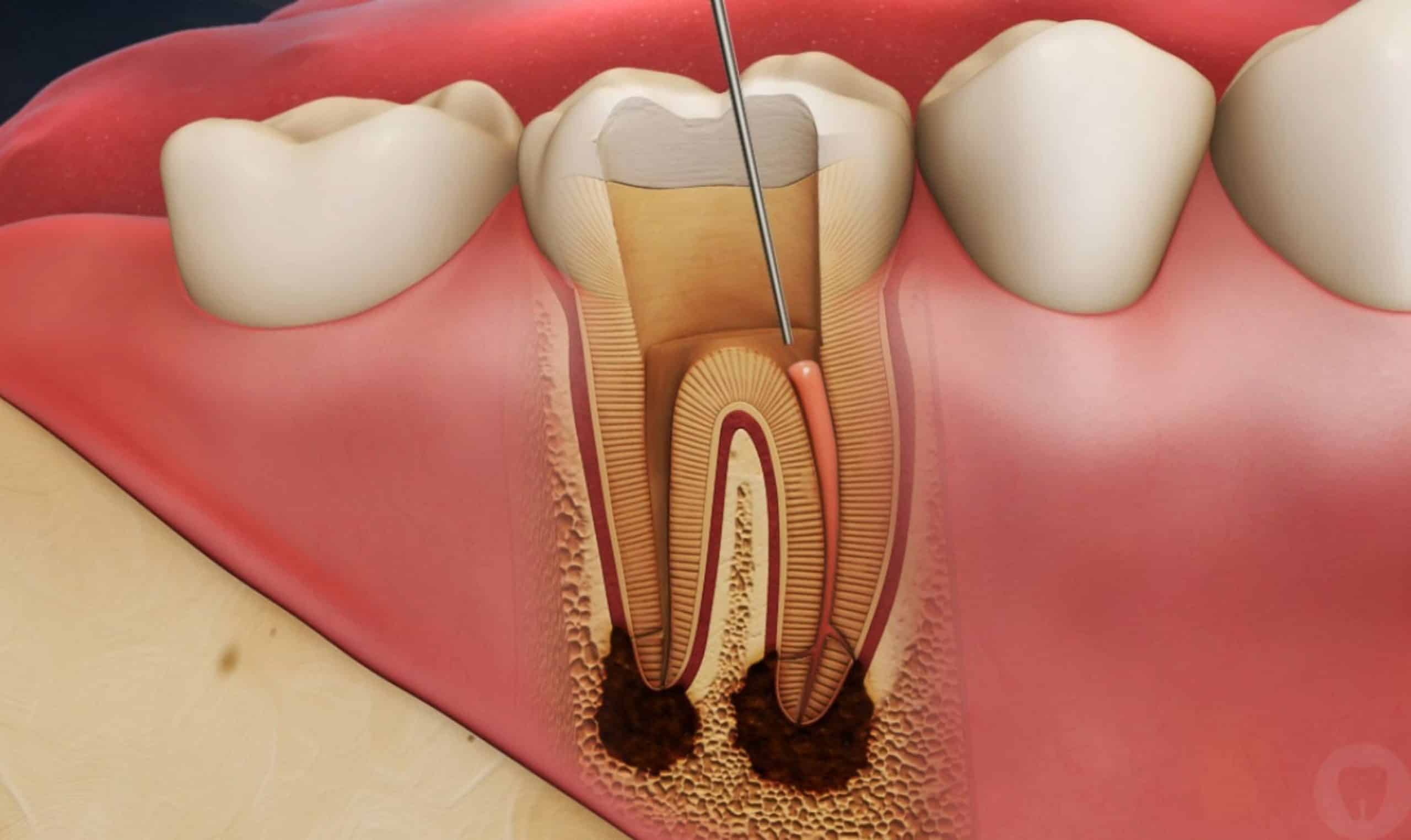 Root Canal Near Dahisar West
