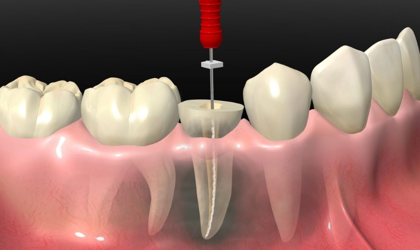 Root Canal Near Dahisar West